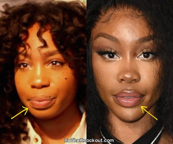 SZA lip fillers before and after comparison photo