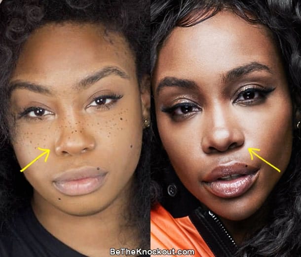 SZA nose job before and after comparison photo
