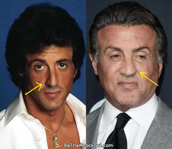 Did Sylvester Stallone have a nose job?
