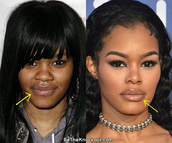 Teyana Taylor lip injections before and after comparison photo