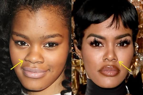 Teyana Taylor nose job before and after comparison photo