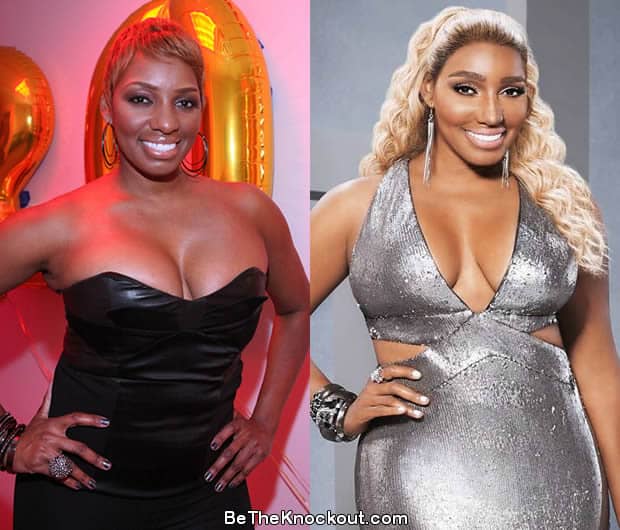 Nene Leakes boob job before and after comparison photo