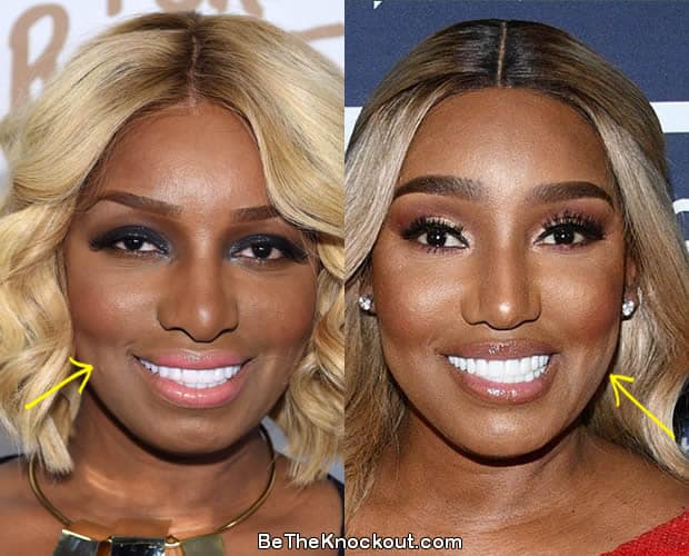 Nene Leakes botox before and after comparison photo