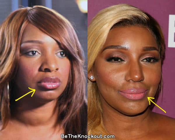 Nene Leakes lip fillers before and after comparison photo