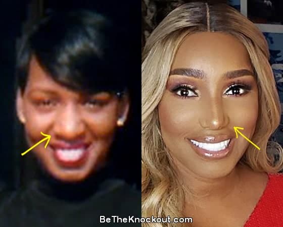 Nene Leakes nose job before and after comparison photo