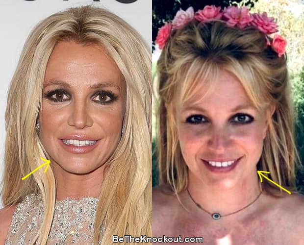 Britney Spears botox before and after photo comparison