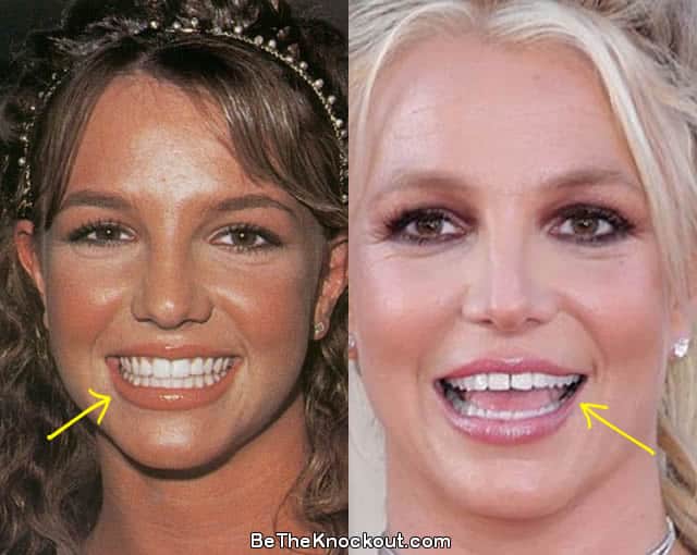 Britney Spears teeth before and after photo comparison
