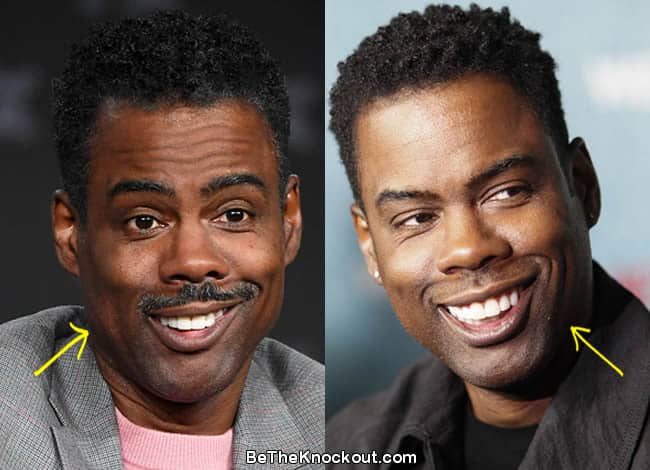 Chris Rock botox before and after comparison photo