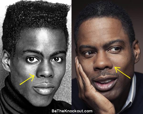 Chris Rock nose job before and after comparison photo