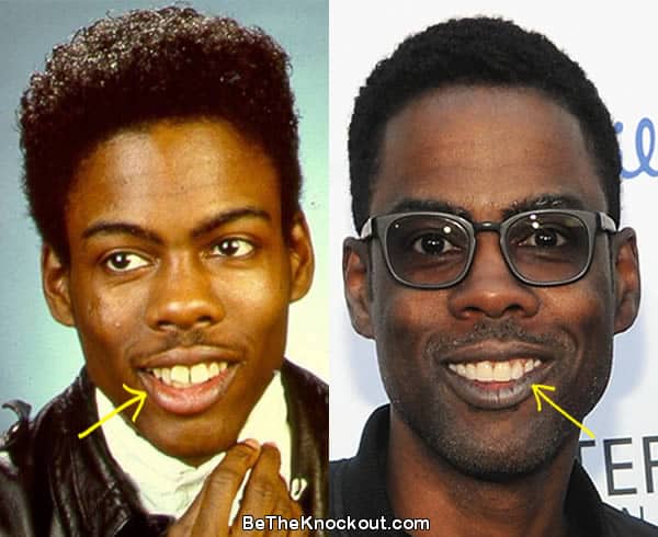 Chris Rock teeth before and after comparison photo