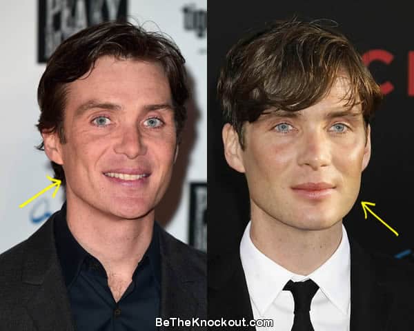 Cillian Murphy botox before and after photo comparison