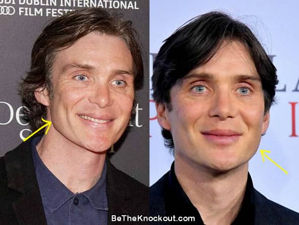 Cillian Murphy face lift before and after photo comparison