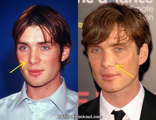 Cillian Murphy nose job before and after photo comparison