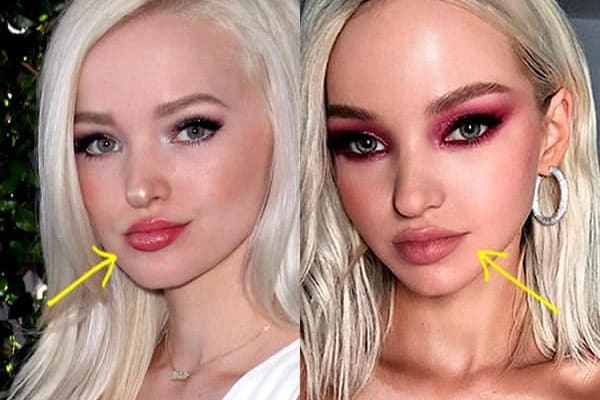 Dove Cameron lip fillers before and after photo comparison