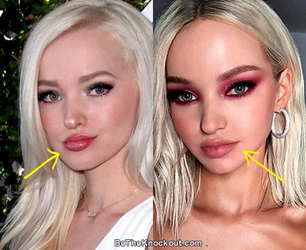 Dove Cameron lip fillers before and after photo comparison