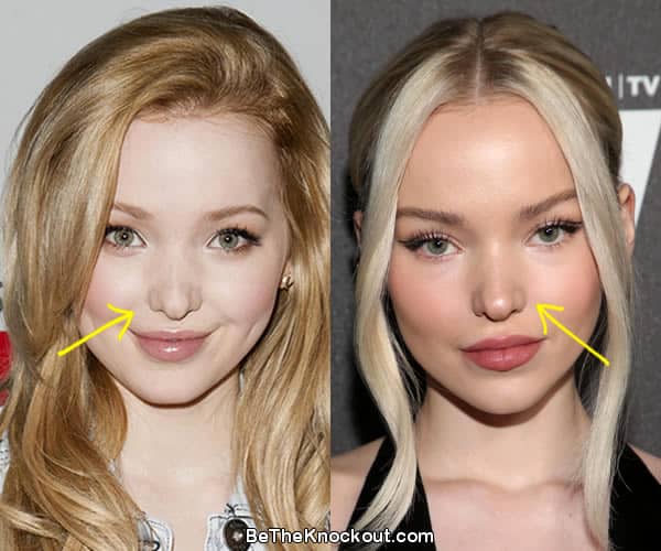 Dove Cameron nose job before and after photo comparison