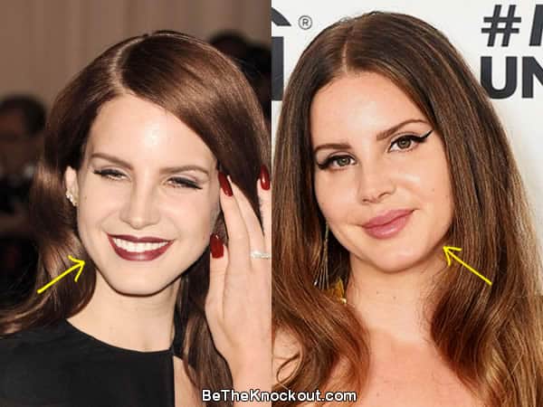 Lana Del Rey botox before and after photo comparison