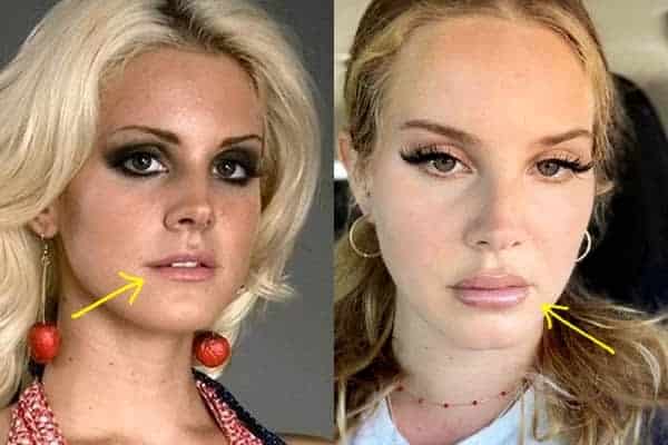 Lana Del Rey lip injections before and after photo comparison