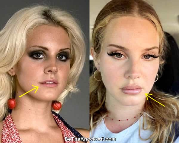Lana Del Rey lip injections before and after photo comparison