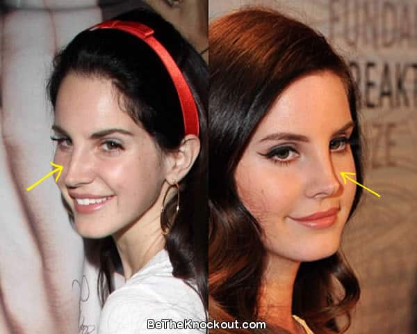 Lana Del Rey nose job before and after photo comparison