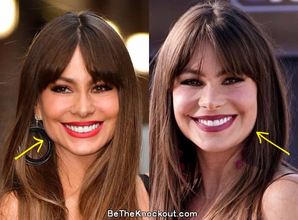 Sofia Vergara botox before and after photo comparison
