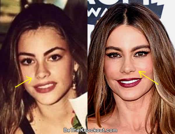 Sofia Vergara nose job before and after photo comparison
