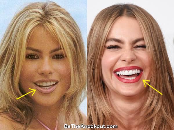 Sofia Vergara teeth before and after photo comparison