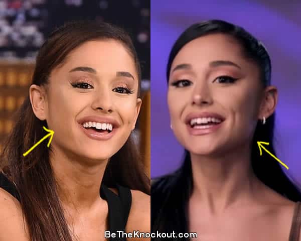 Ariana Grande botox before and after comparison photo