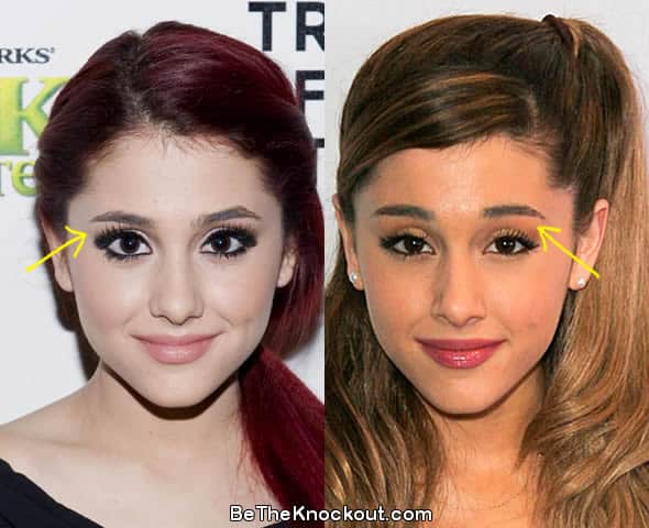 Ariana Grande brow lift before and after comparison photo