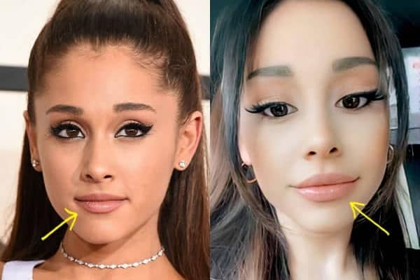 Ariana Grande lip fillers before and after comparison photo
