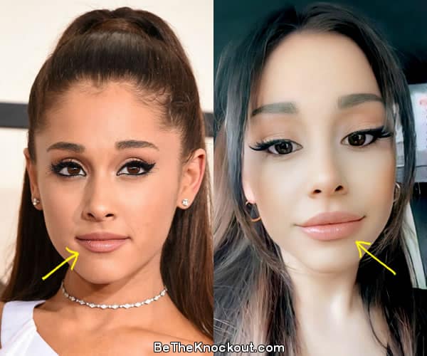 Ariana Grande lip fillers before and after comparison photo