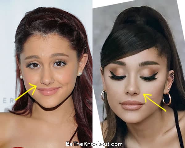 Ariana Grande nose job before and after comparison photo