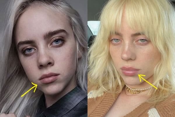 Billie Eilish lip injections before and after comparison photo