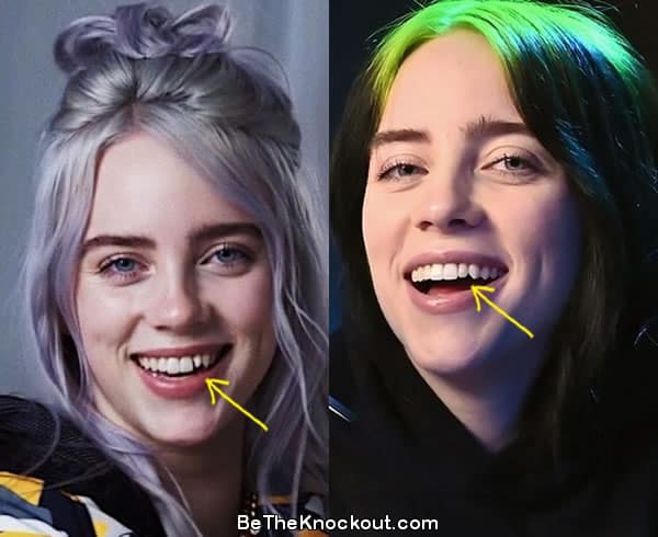 Billie Eilish teeth before and after comparison photo