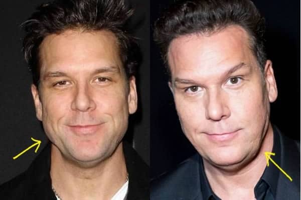 Dane Cook botox before and after comparison photo