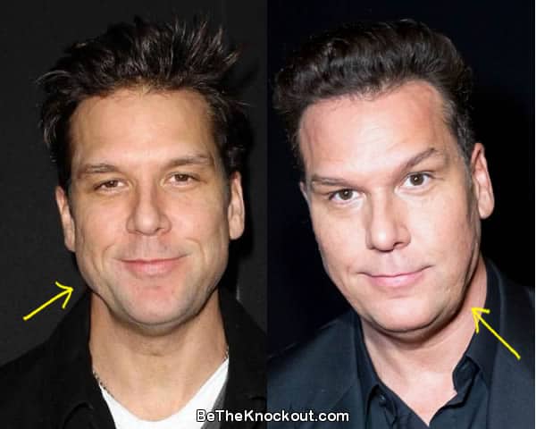 Dane Cook botox before and after comparison photo
