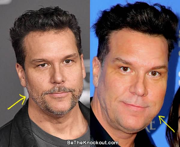 Dane Cook facelift before and after comparison photo