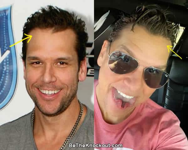 Dane Cook hair transplant before and after comparison photo