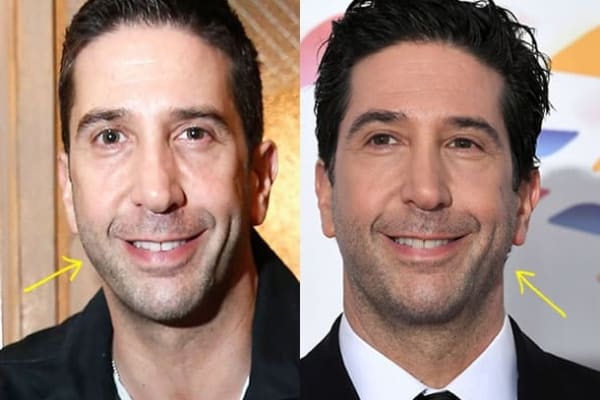 David Schwimmer botox before and after comparison photo