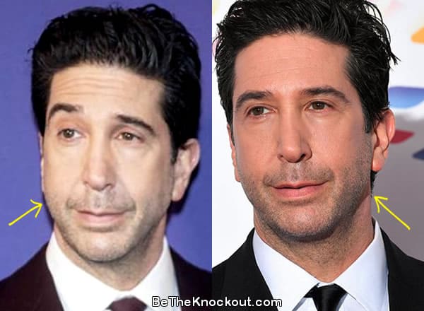 David Schwimmer facelift before and after comparison photo