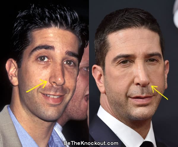 David Schwimmer nose job before and after comparison photo