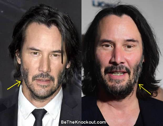 Keanu Reeves facelift before and after comparison photo