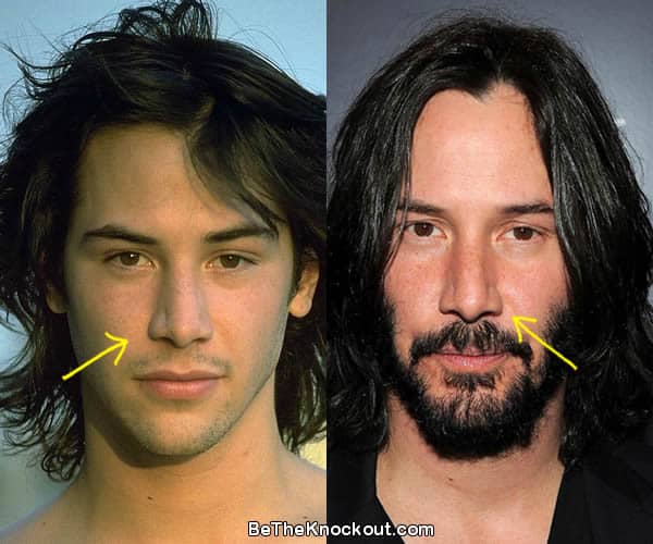 Keanu Reeves nose job before and after comparison photo