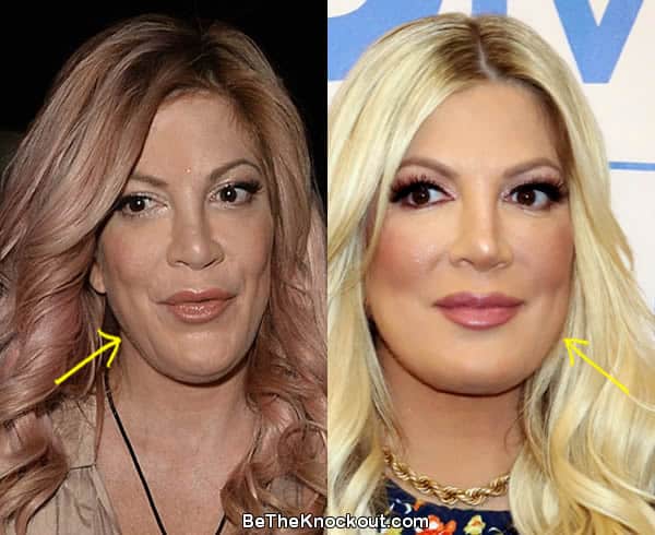 Tori Spelling facelift before and after comparison photo