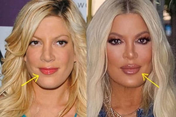 Tori Spelling lip fillers before and after comparison photo