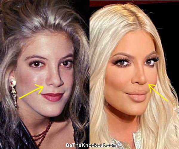 Tori Spelling nose job before and after comparison photo