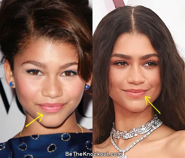 Zendaya lip fillers before and after comparison photo