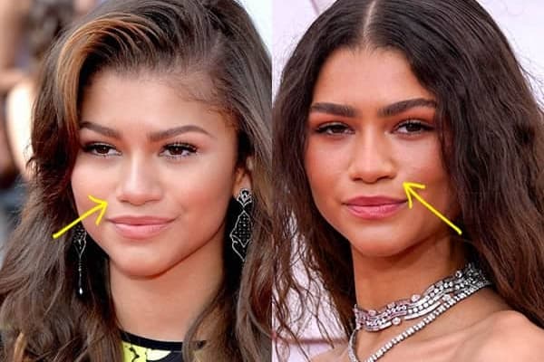 Zendaya nose job before and after comparison photo