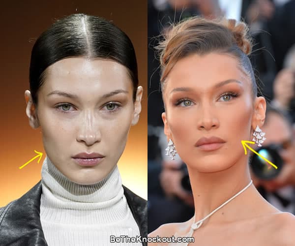 Bella Hadid facelift before and after comparison photo