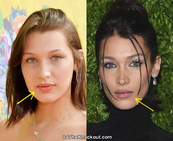 Bella Hadid lip fillers before and after comparison photo